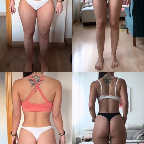 caso_marta_esta_chica_tiene_lipedema_2_1x